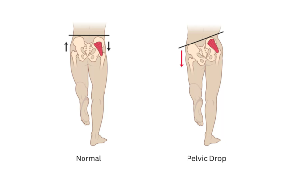 Drop Injury Why do you have back pain when running? - Athletico